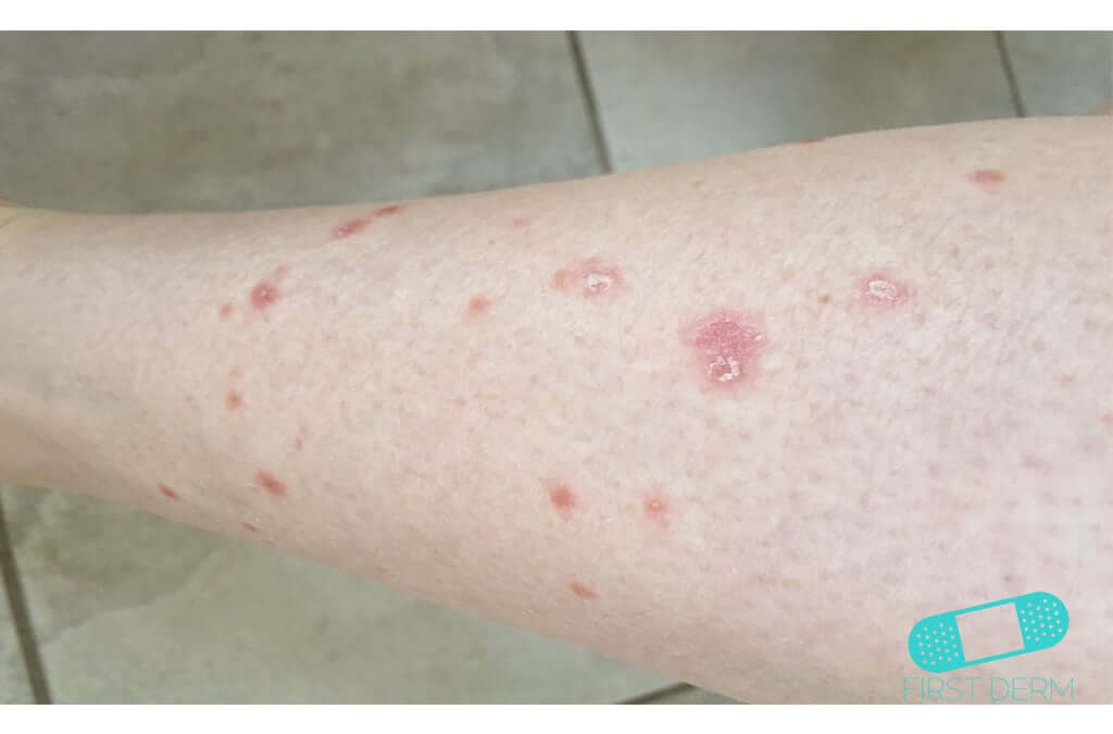 psoriasis-leg-itchy-red-bumps