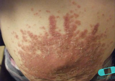 Psoriasis (20) belly [ICD-10 L40.9]