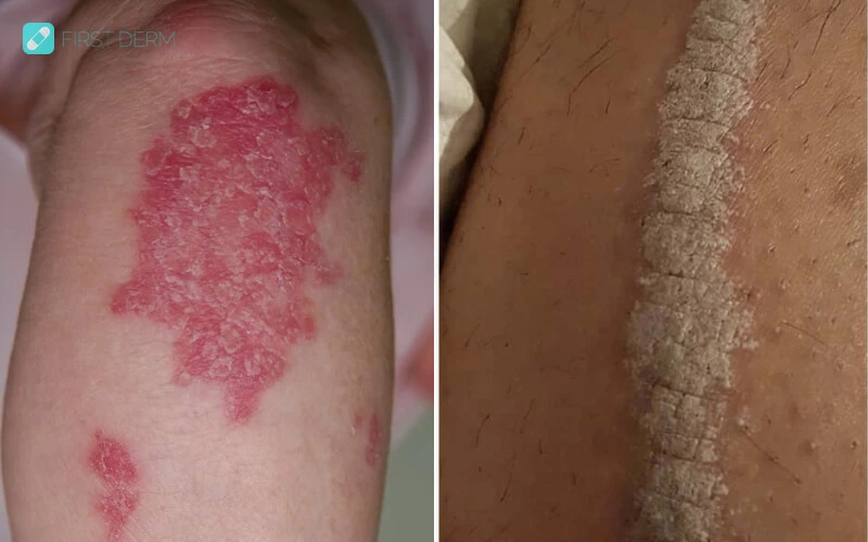 Psoriasis, a skin condition related with mind skin connection, usually appears near knees, elbows, scalp, and lower back