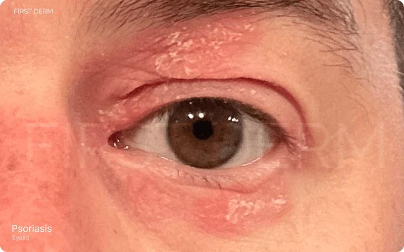 An individual's eyes showing symptoms of psoriasis on the eyelids, characterized by dry, flaky skin that has hardened into patches. The affected areas, extending from the upper eyelids to the eyebrows and along the lower eyelids, appear red, shiny, and inflamed, indicating pain and discomfort. The skin's texture is visibly rough and peeling, highlighting the severity of the condition.