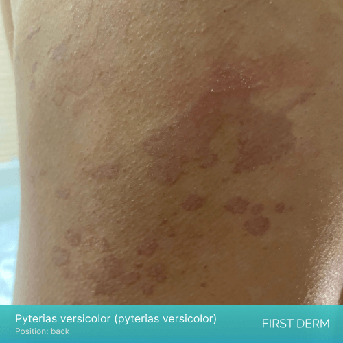 A close-up view of a person's back showing reddish patches of varying sizes and tones caused by an infection of Pyterias versicolor