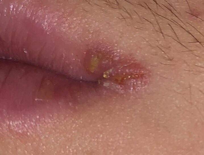 Reddit Skincare Cold sore herpes simplex lips help