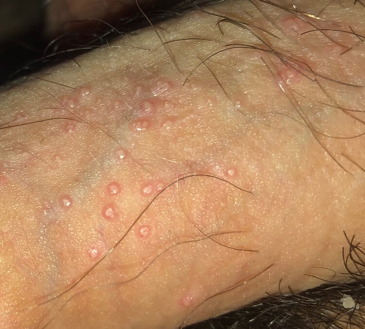 Reddit Skincare Molluscum contagiosum penis help