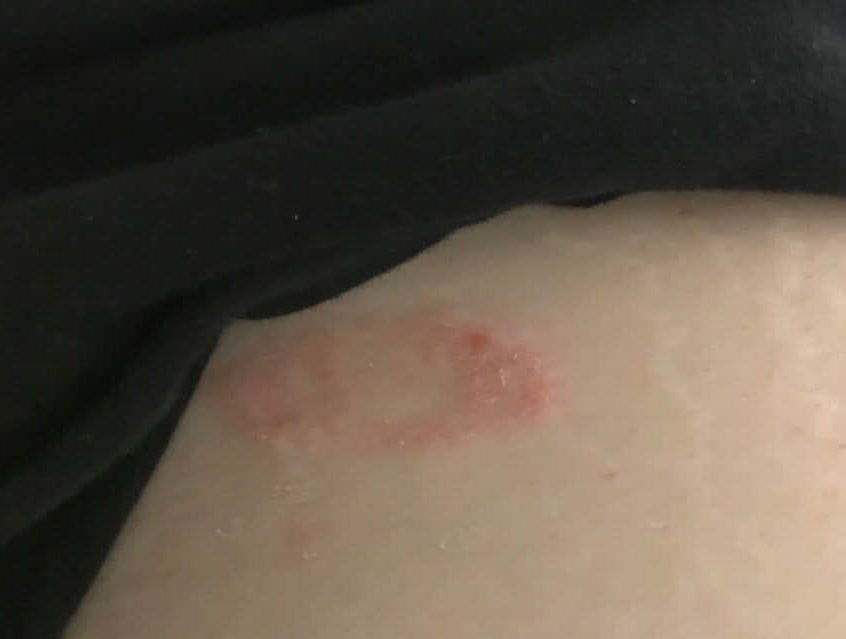 Ringworm in the Groin Area help: Image depicting the common symptoms of ringworm infection, showing a circular, red rash with raised, scaly edges on the skin