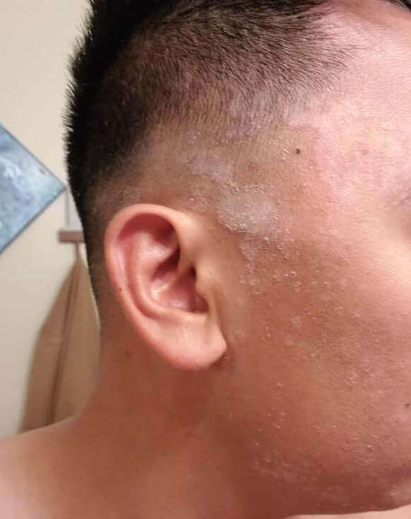 Reddit Skincare fungal face help