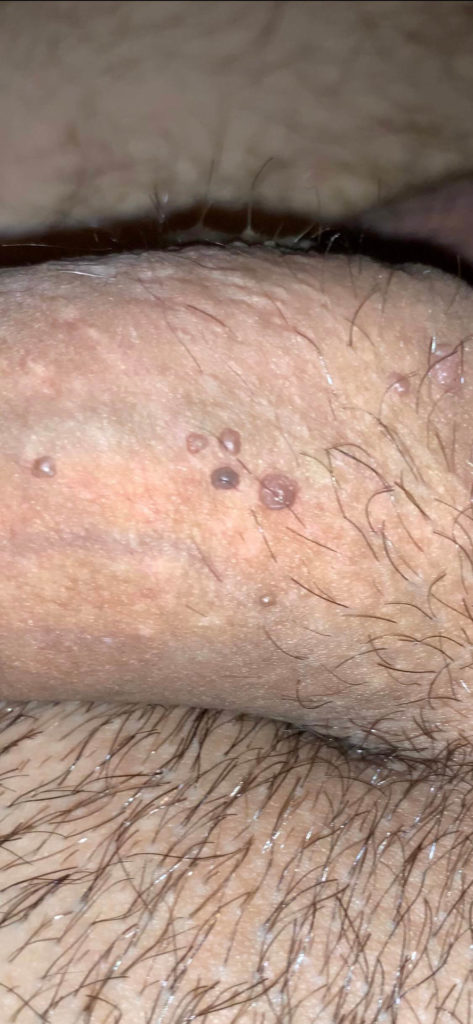 Reddit Skincare genital warts HPV penis help