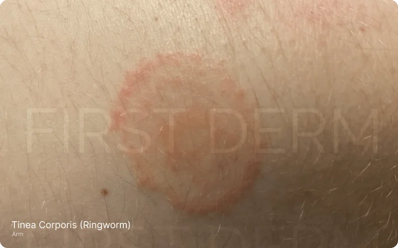Image depicting a ring-shaped, slightly raised, reddish rash characteristic of tinea corporis (ringworm)