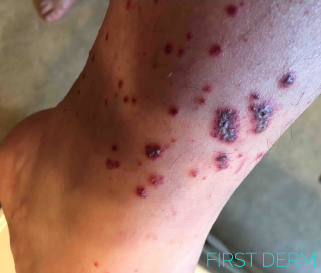 Rocky Mountain Spotted Fever vasculitis ICD 10 A77.0