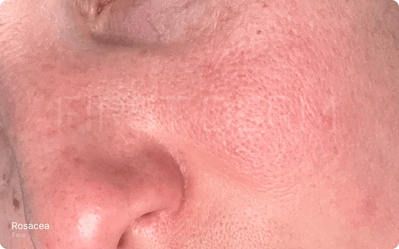 Close-up image capturing the effects of winter-induced rosacea on the skin, featuring a slightly reddish cheek with signs of dryness, sensitivity, and fine lines, highlighting the detailed texture of affected skin