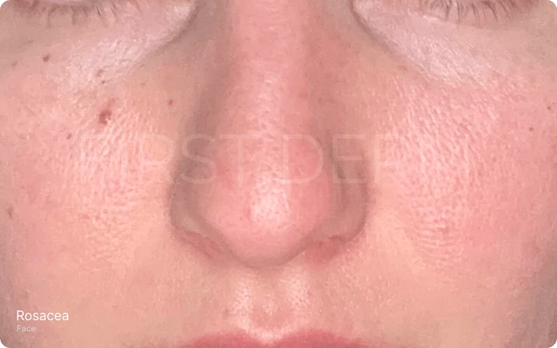 face affected by rosacea, focusing on the lower half excluding eyes and mouth, showing dry, rough skin with visible redness, enlarged pores, and subtle signs of stretched skin around the nostrils and cheeks 