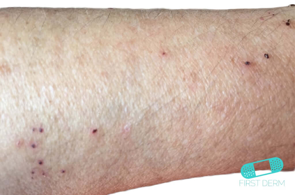 Scabies (01) arm [ICD-10 B86]