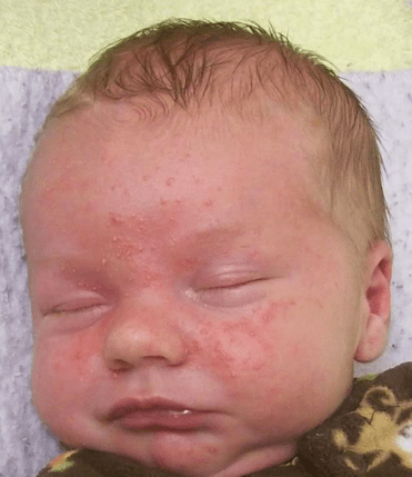 Newborn baby with acne on face