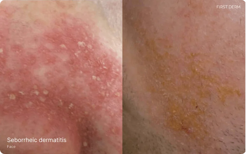 Seborrheic Dermatitis, particularly located at the nasolabial folds, marked by inflamed, reddish skin with flaky white patches. The second image on right reveals yellowish patches or scales on the face
