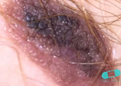 Seborrheic Keratosis (Senile warts) (01) skin [ICD-10 L82.1]