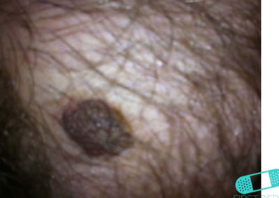 Seborrheic Keratosis (Senile warts) (20) skin [ICD-10 L82.1]