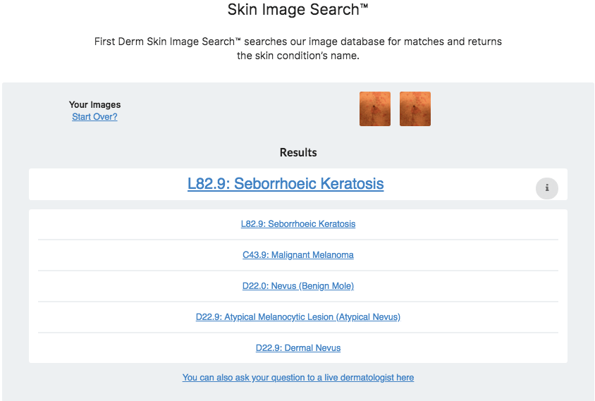 Seborrheic Keratosis Skin Image Search AI_2