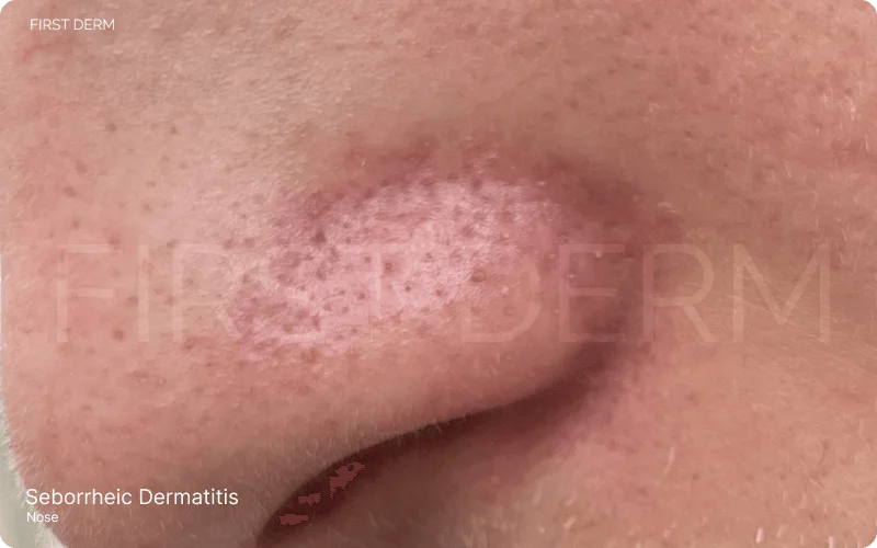 displaying pronounced redness around the corners of the nose, characteristic of Seborrheic Dermatitis