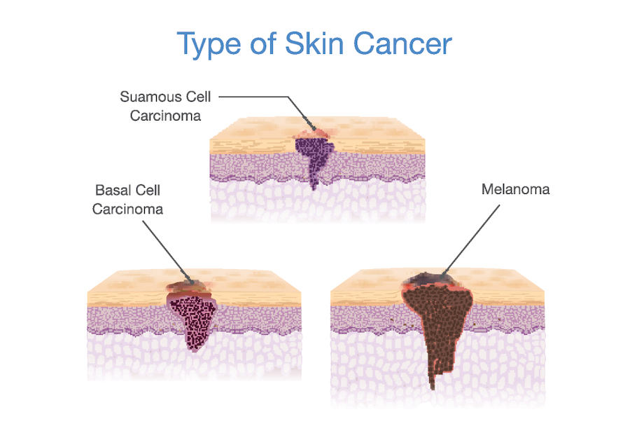 skin-cancer-mole-types hudcancer typer av födelsemärken