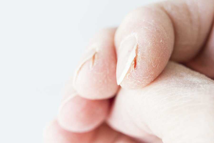 skin-fissure-split-fingertips