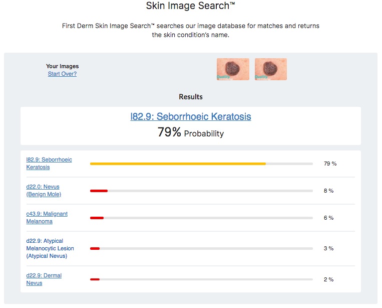 Hudappen jämfört med internetsökning visar Seborroisk Keratos, hudläkare bekräftat (senilvårta)