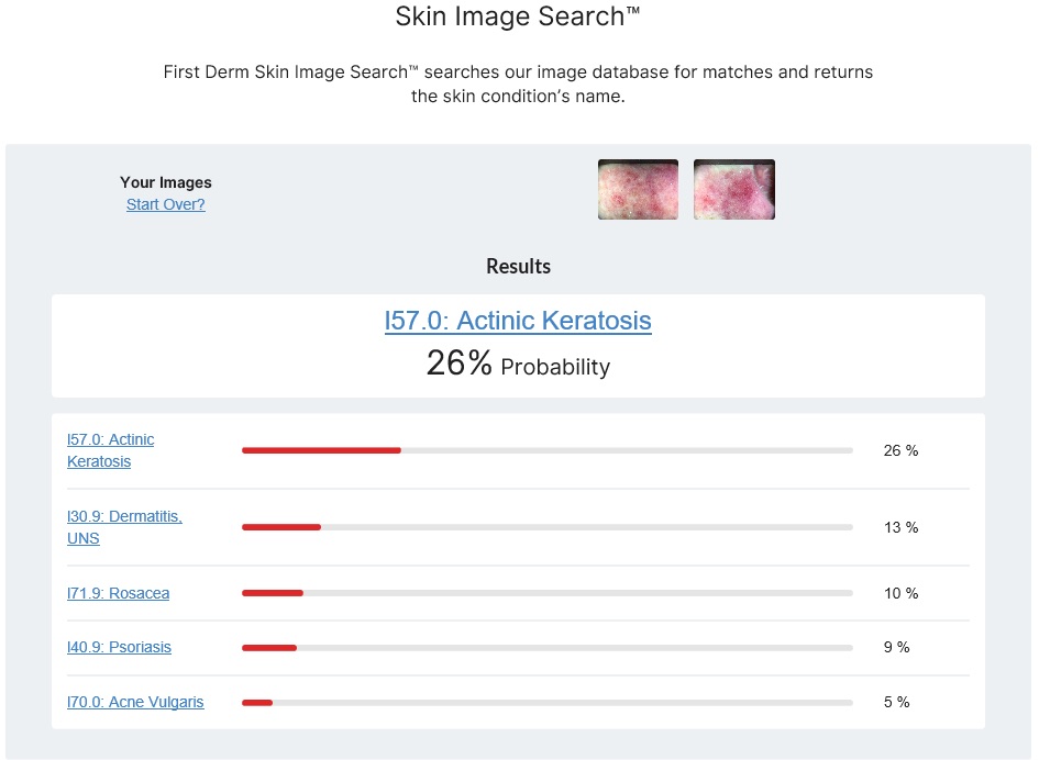 Buscador de imágenes de la piel - testimonio - Queratosis actínica