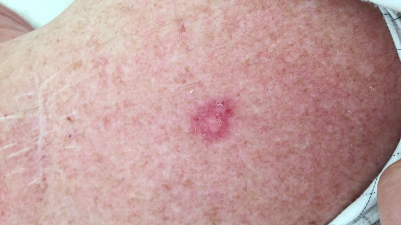 Skin cancer pictures high quality Basal Cell Cancer on arm