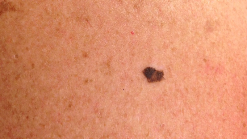 Skin cancer pictures high quality of malignant melanoma on the back ICD 10 C43.9