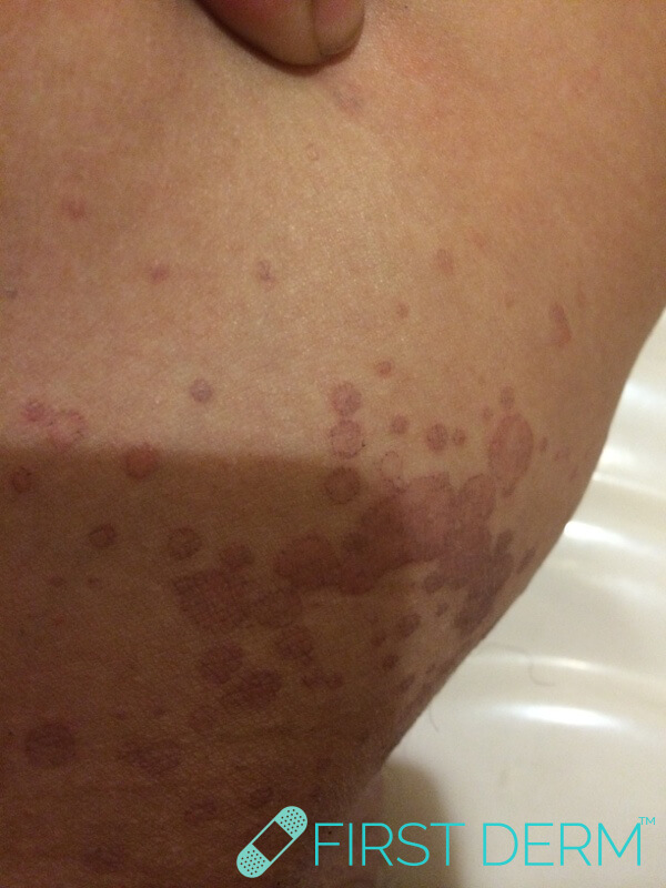 Skin rash DERMATOPHYTOSIS- Fungal infection, hair or nails left arm female no symptoms