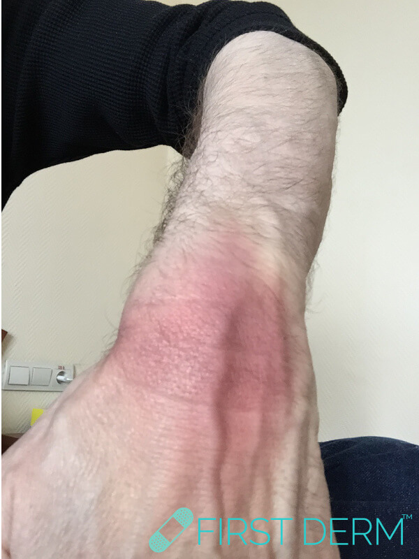 Hautausschlag fixierte Arzneimittelreaktion linkes Handgelenk männlich sieht aus wie Sonnenbrand