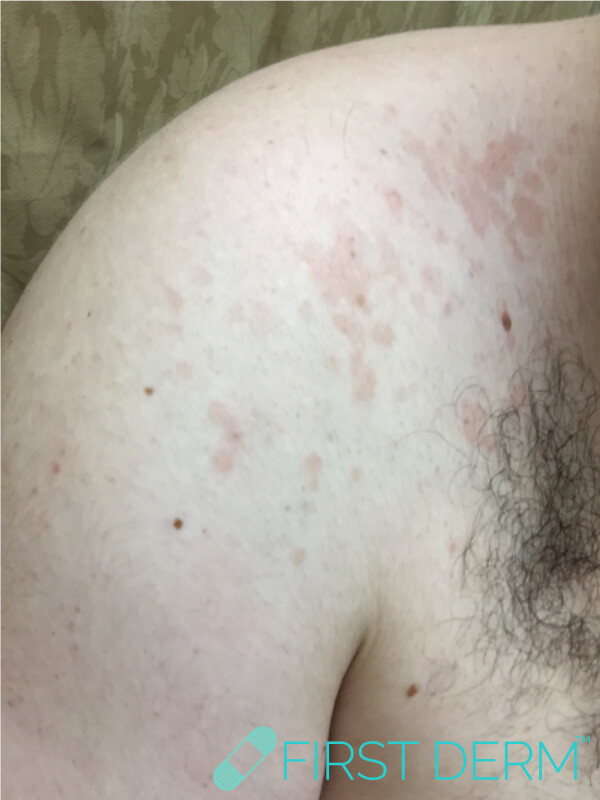 Hautausschlag Tinea versicolor linke Schulter männlich gestresst