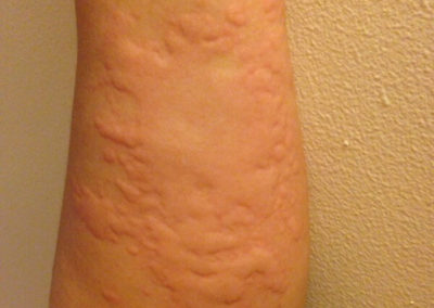 Skin rash urticaria hives left arm legs trunk female