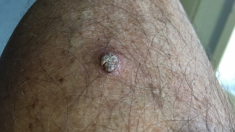 Squamous Cell Carcinoma (SCC) man leg high quality picture