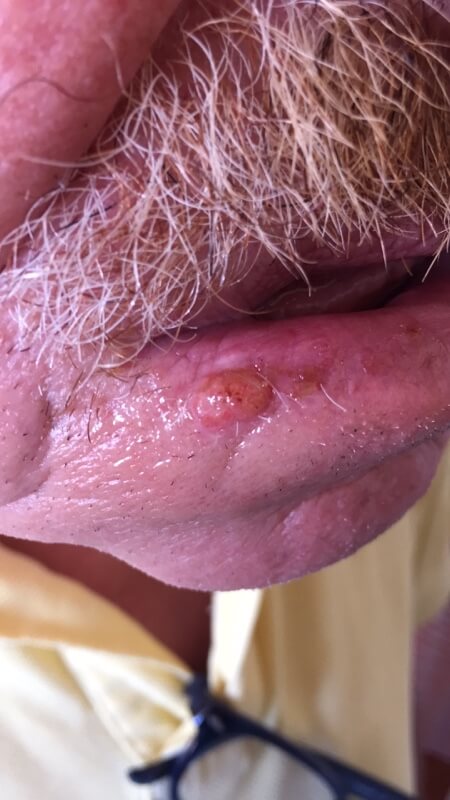Squamous Cell Carcinoma lip high quality picture
