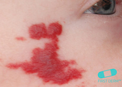 Stork Bite (Angel Kisses or Salmon Patches) (02) cheek [ICD-10 Q82.5]