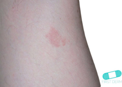 Strawberry marks (Hemangioma) (01) skin [ICD-10 D18.00]