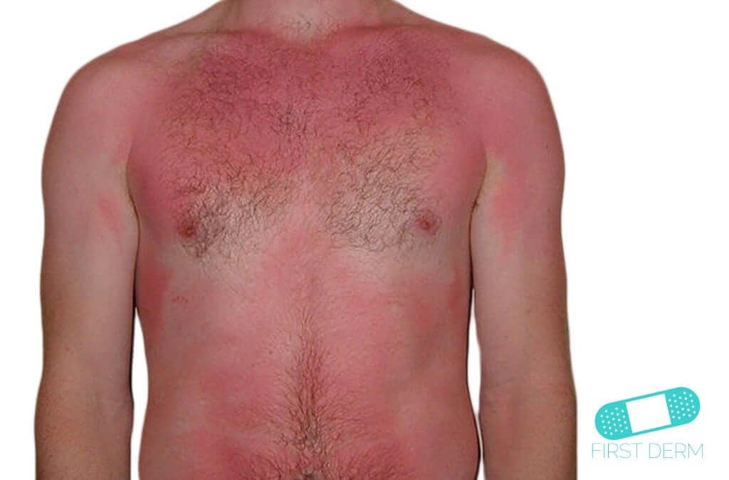 Sunburn and Sun Eczema (01) chest [ICD-10 L55.9]