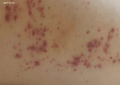 swimmer’s itch in the initial stage with tiny flat red spots