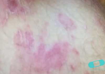 Tinea infections body