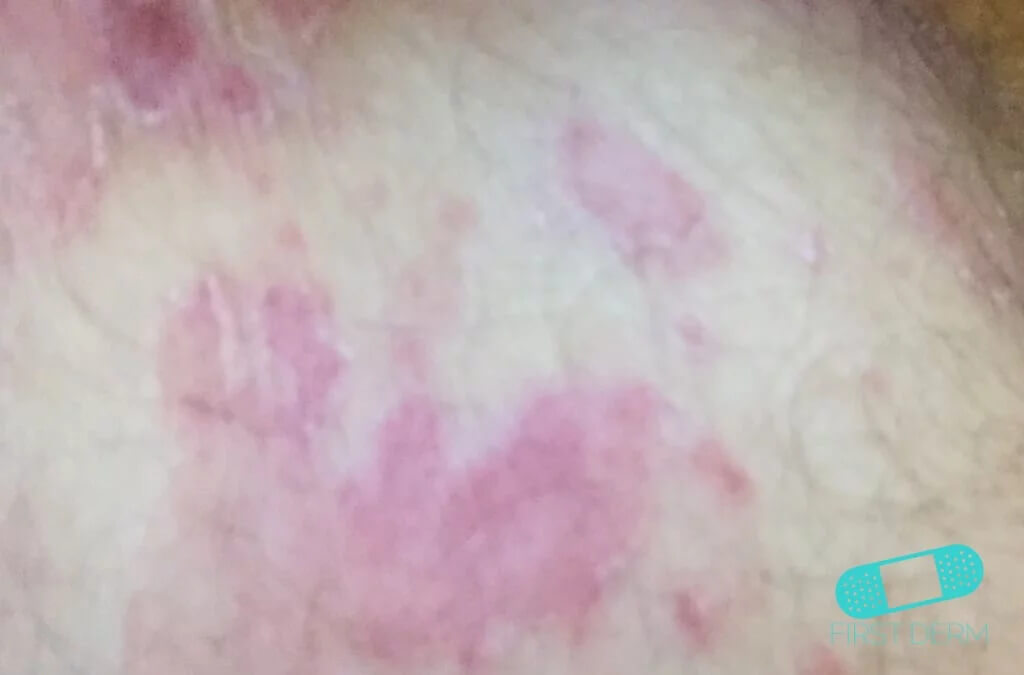 Reddish ring shaped raised spots due to Tinea infection<br />

