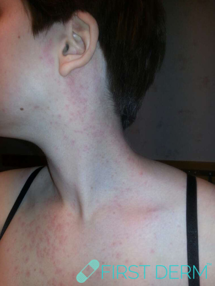 Travel rash Mallorca-acne on face
