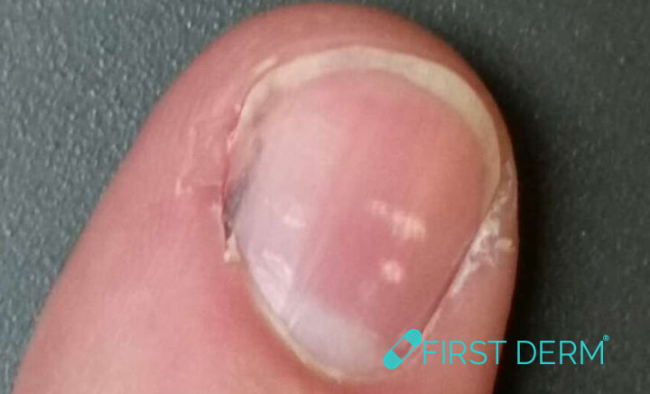 White spots on skin Leukonychia medial nail dystrophy