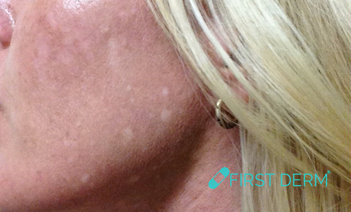 White spots on skin sun damage SOLARIS hypogimentation