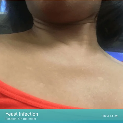 A woman’s upper body showing signs of yeast infection on her chest, with visible white patches