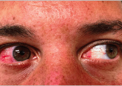 Zikavirus (utslag) (01) ögon [ICD-10 A92.5]