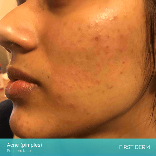 Image of an Indian girl with mild acne on her face. The acne appears as small bumps on her skin, particularly on her cheeks, with a reddish tone. There is no visible oozing or liquid coming out of the pimples