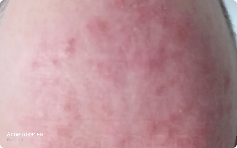 Close-up of forehead showing small red spots and general redness, indicative of Acne Rosacea, an inflammatory condition common in adults over 30. Features patches and discolorations without constant itch