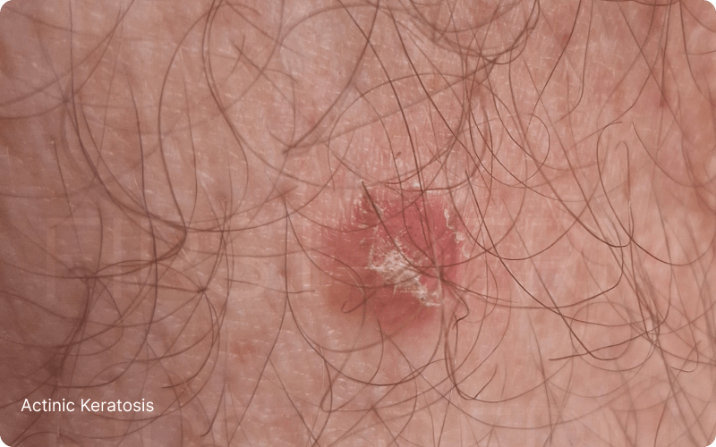 Actinic keratosis on sun-damaged skin, featuring persistent red and scaly patches. Commonly found in individuals with fair skin, this precancerous lesion requires professional dermatological evaluation and possible biopsy for confirmation and treatment