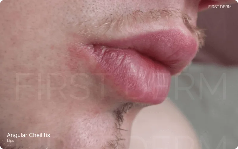 Red irritated skin at the corners of the mouth indicating symptoms of Angular Cheilitis, characterized by dryness, cracking, redness, and irritation in the affected area
