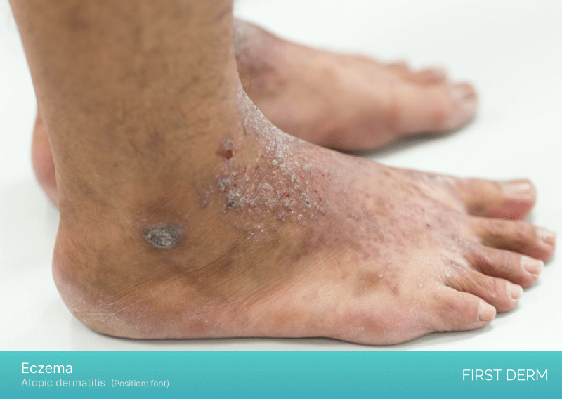 An image of atopic dermatitis on a person's foot, showing red, itchy, inflamed patches of skin with areas of dryness, scaling, and possible oozing or crusting