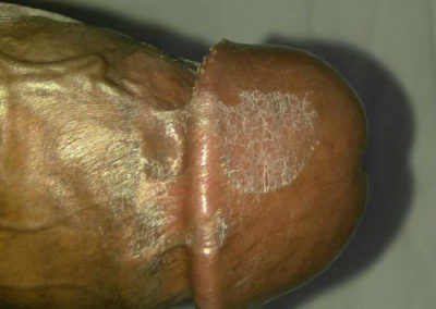 Balanitis Circinata - penis (2)